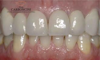 Kit Impiallacciature Dentali In Resina Composita Per Sbiancamento E Estetica, Nuovo, Per Uso Professionale In Laboratorio Odontoiatrico